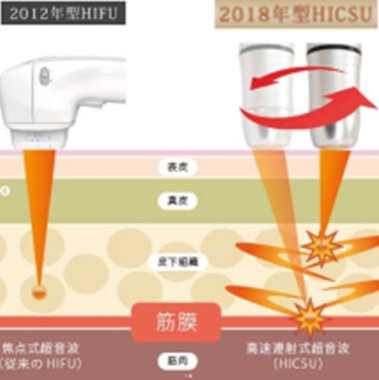 光脱毛